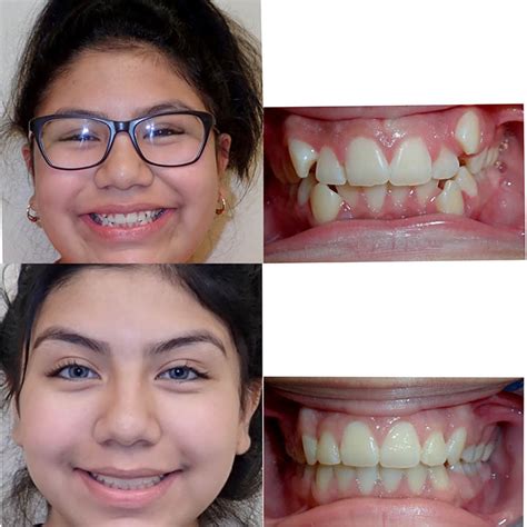 Before & After Braces | Wazio Orthodontics