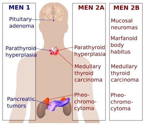 Multiple Endocrine Neoplasia | Concise Medical Knowledge