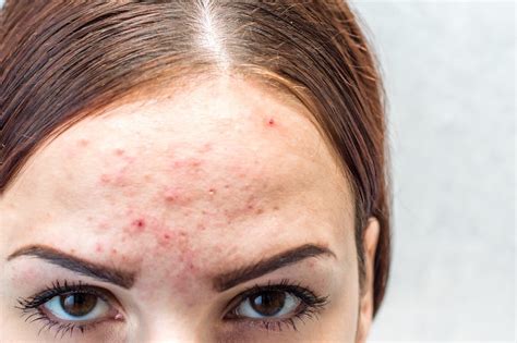 Pimples on forehead: What are the Causes & Treatments?