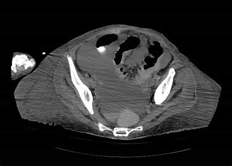 Hemoperitoneum - wikidoc