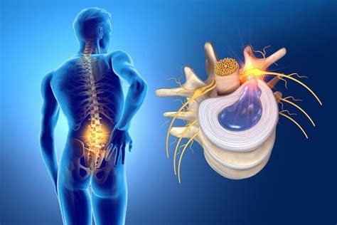 Herniated Disc Treatment