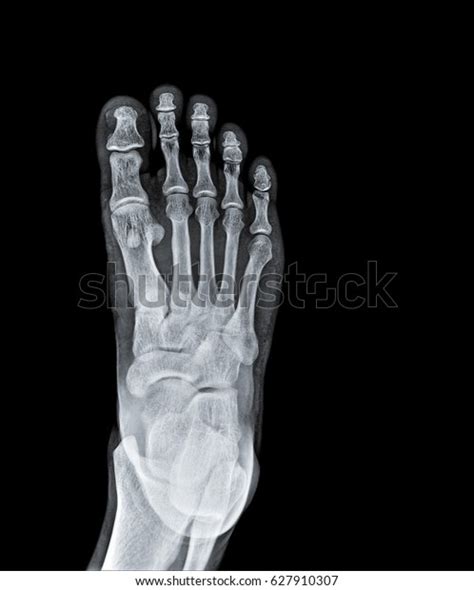 X Ray Foot Showing Tarsal Bone 스톡 사진 627910307 | Shutterstock