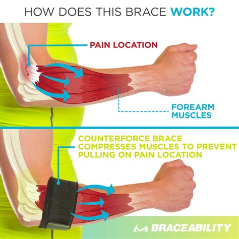 Tendonitis Counterforce Brace | Tennis & Golfers Elbow Support Strap