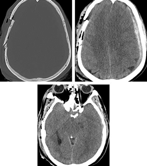 Simple Skull Fracture