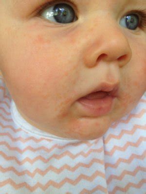 Teething rash?? - April 2016 - BabyCenter Australia