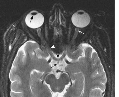 Optic Nerve | Radiology Key