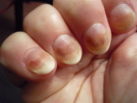 I can't believe how many disease can be identified early just by looking at your fingernails ...