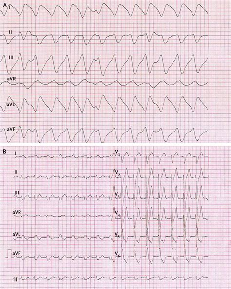 An Electrocardiographic Sine Wave in Hyperkalemia | NEJM