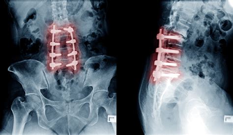 Posterior Lumbar Decompression and Fusion surgery | PLDF Surgery