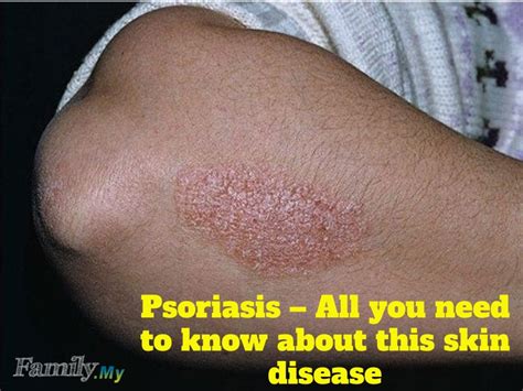 Psoriasis – All you need to know about this skin disease - Malaysia ...