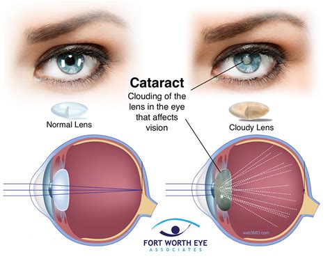 cataract lens FW eyes - Fort Worth Eye Associates