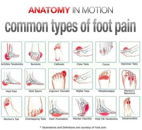 Sore feet these common causes of foot pain could be to blame – Artofit