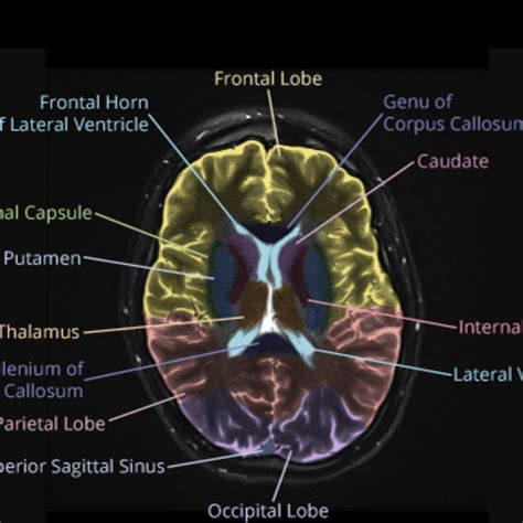 Brain Lobes Labeled Mri at Harold Cook blog