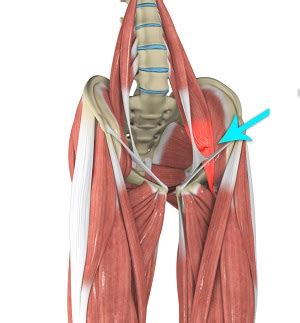 Hip Flexor Pain Causes