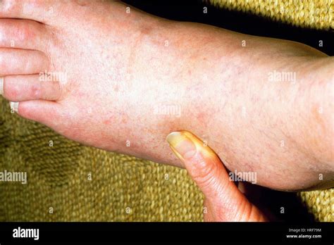 Pitting edema of the foot Stock Photo - Alamy