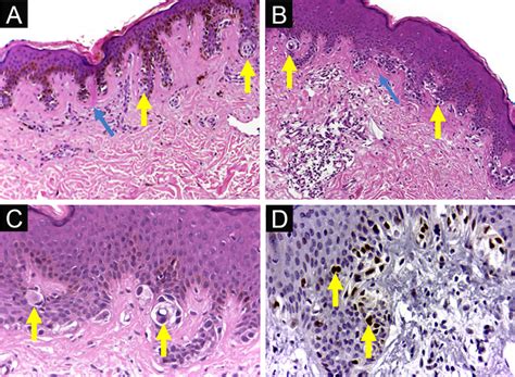 Dysplastic nevus syndrome: (A) Classical Dysplastic Nevus (CDN ...