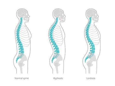 Swayback Posture: Causes, Risks, And Treatment - Physio Ed.