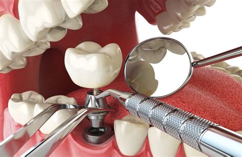 DENTAL IMPLANTS PROCEDURE - Dr Paulo Pinho