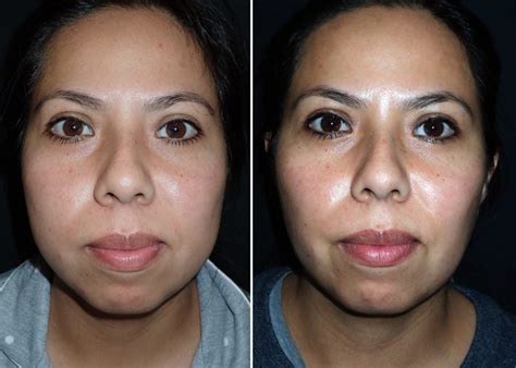 Buccal Fat Pad Reduction Richmond VA | Midface Procedure