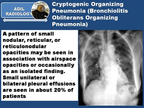 CRYPTOGENIC ORGANIZING PNEUMONIA... - Radiology Classroom