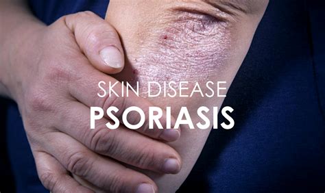 Psoriasis Skin Disease