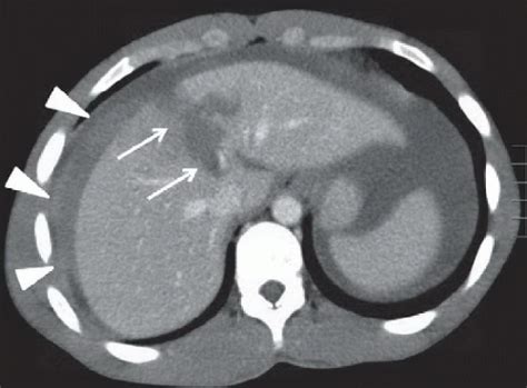 Liver Laceration | Radiology Key