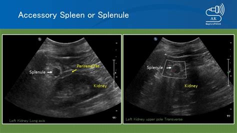 Accessory Spleen – NephroPOCUS