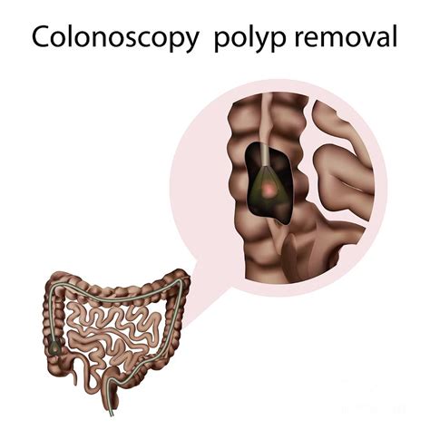 Colonoscopy Polyp Removal Photograph by Veronika Zakharova/science Photo Library