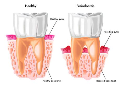 Periodontitis Treatment Specialist Sydney | ADS