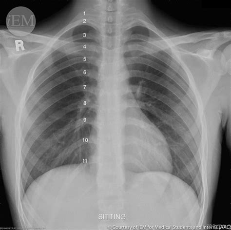 How to read chest x-rays – International Emergency Medicine Education Project