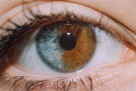 In people affected by complete heterochromia, one iris is a different ...