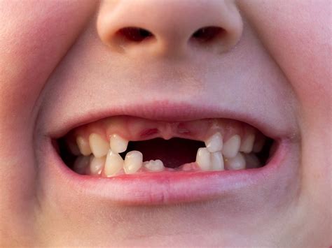 CDC: Fewer U.S. kids are getting cavities - UPI.com