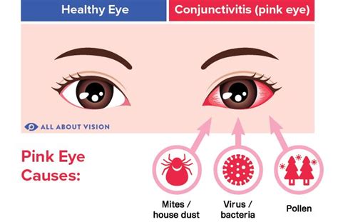 Pink Eye (Conjunctivitis) Causes - All About Vision