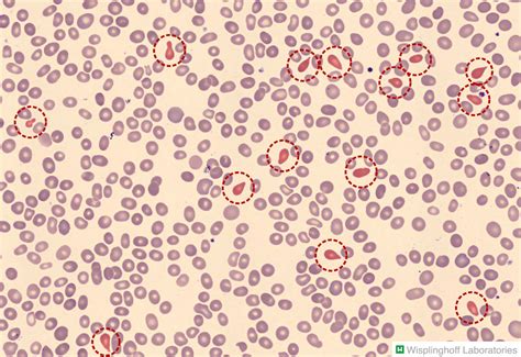 Thalassemia Blood