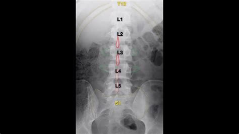 Lumbar Spine Xray Anatomy