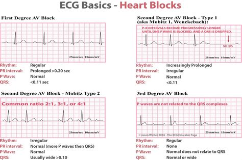 Heart block causes, symptoms, types, diagnosis and heart block treatment