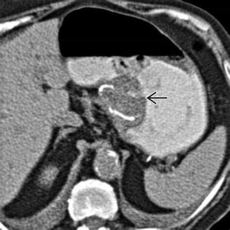 Fundoplication Complications | Clinical Gate