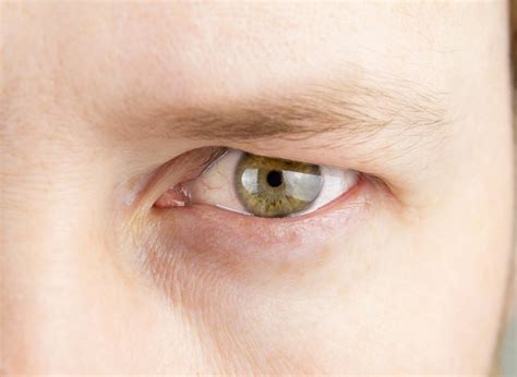 Droopy Eyelid: Causes, Symptoms, And Treatment Of Ptosis