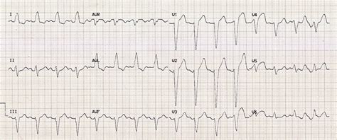 Left Bundle Branch Block Ekg Examples