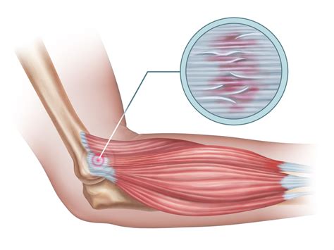 Tennis Elbow Causes and Treatment | AZ Pain Specialists