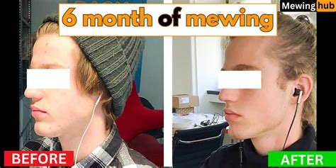 Crazy Mewing before and after ! – Mewinghub