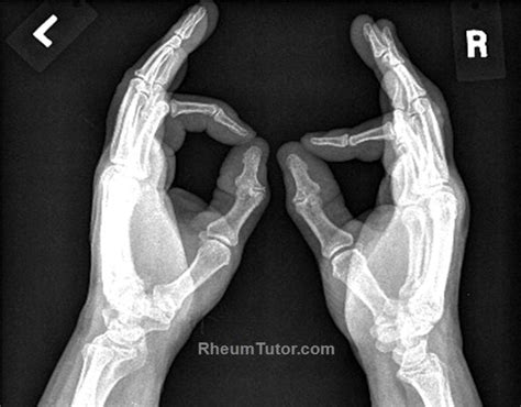 Xray Of Hand Bones