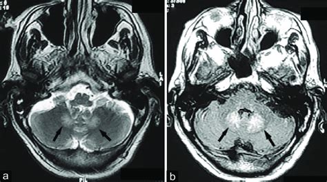 MRI brain in axial view at the level of the pons showing signal ...