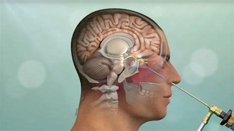 Minimally Invasive Brain Surgery | Keyhole Craniotomy | Pacific Brain Tumor Center