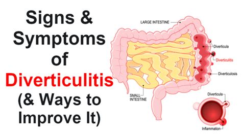 Signs & Symptoms of Diverticulitis (& Ways to Improve It) - WomenWorking