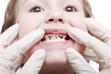 Cavities in Children - New Kids Center