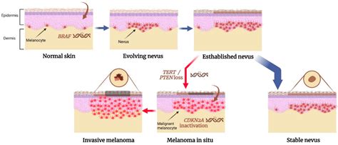 Intradermal Nevus Symptoms Causes And Treatments