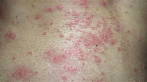 Bacterial Skin Rash Symptoms And Treatment Detailed Review – NBKomputer