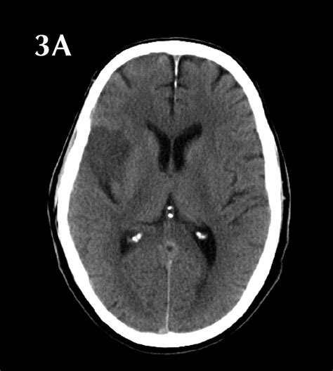 The eyes have it: conjugate eye deviation on CT scan aids in early detection of ischemic stroke ...