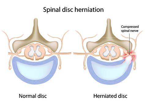 Advanced Spine: Disc Herniation Relief Westchester - Herniated Disc Exercises